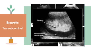 Ecografía
Transabdominal
 