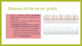 BLOQUEO AURICULO VENTRICULAR EN PACIENTE CRITICO. | PPTX