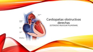 Cardiopatias obstructivas
derechas
(ESTENOSIS VALVULAR PULMONAR)
 