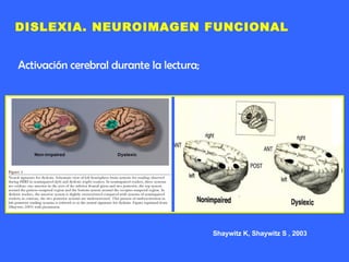 Shaywitz K, Shaywitz S , 2003 DISLEXIA. NEUROIMAGEN FUNCIONAL Activación cerebral durante la lectura; 