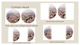 Campo visual
Paris visto con campo visual normal
Hemianopsia bitemporal
Hemianopsia binasal
Hemianopsia homónima
 