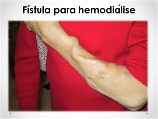 Fístula para hemodiálise
 