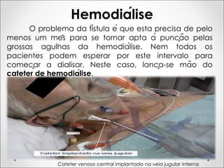 Hemodiálise
O problema da fístula é que esta precisa de pelo
menos um mês para se tornar apta à punção pelas
grossas agulhas da hemodiálise. Nem todos os
pacientes podem esperar por este intervalo para
começar a dialisar. Neste caso, lança-se mão do
cateter de hemodiálise.
.
Cateter venoso central implantado na veia jugular interna
 