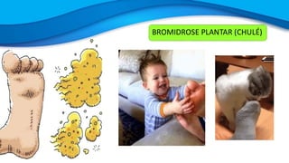 BROMIDROSE PLANTAR (CHULÉ)
 