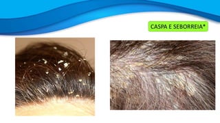 CASPA E SEBORREIA*
 