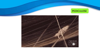 PEDICULOSE
 