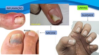 MICOSE
SUJIDADE
INFLAMAÇÃO UNHAS
 
