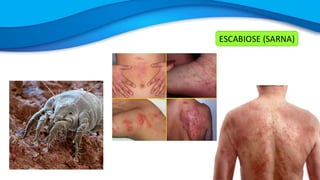 ESCABIOSE (SARNA)
 