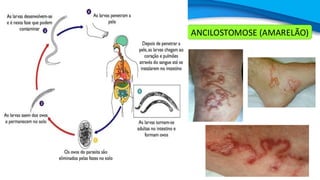 ANCILOSTOMOSE (AMARELÃO)
 