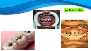 CÁRIE DENTÁRIA
 