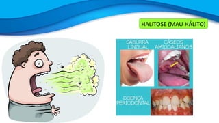 HALITOSE (MAU HÁLITO)
 