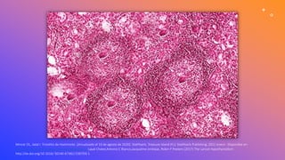 Mincer DL, Jialal I. Tiroiditis de Hashimoto. [Actualizado el 10 de agosto de 2020]. StatPearls. Treasure Island (FL): StatPearls Publishing; 2021 enero-. Disponible en:
https://www.ncbi.nlm.nih.gov/books/NBK459262/ Layal Chaker,Antonio C Bianco,Jacqueline Jonklaas, Robin P Peeters (2017) The Lancet Hypothyroidism.
http://dx.doi.org/10.1016/ S0140-6736(17)30703-1
 