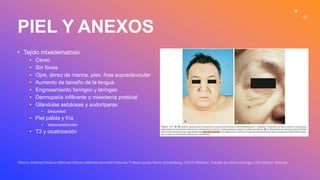 PIEL Y ANEXOS
• Tejido mixedematoso
• Céreo
• Sin fóvea
• Ojos, dorso de manos, pies, fosa supraclavicular
• Aumento de tamaño de la lengua
• Engrosamiento faríngeo y laríngeo
• Dermopatía infiltrante o mixedema pretibial
• Glándulas sebáceas y sudoríparas
• Sequedad
• Piel pálida y fría
• Vasoconstricción
• T3 y cicatrización
Shlomo Melmed Shlomo Melmed Shlomo Melmed Kenneth Polonsky P. Reed Larsen Henry Kronenberg. (2017) Williams. Tratado de endocrinología 13th Edition. Elsevier
 