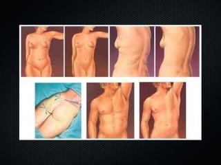 Cirurgia Plástica de Lipoaspiração