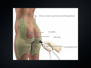 Área onde a gordura será aspiradaÁrea onde a gordura será aspirada
IncisãoIncisão
CânulaCânula
LipoaspiradorLipoaspirador
 
