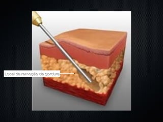 Local da remoção da gorduraLocal da remoção da gordura
 