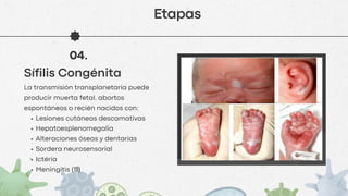 Microbiología Sifilis caracteristicas del sifilis | PDF