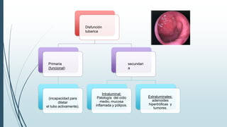 Disfunción
tubarica
Primaria
(funcional)
(incapacidad para
dilatar
el tubo activamente).
secundari
a
Intraluminal:
Patología del oído
medio, mucosa
inflamada y pólipos.
Extraluminales:
adenoides
hipertróficas y
tumores.
 