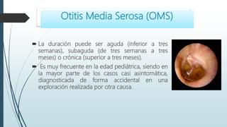  La duración puede ser aguda (inferior a tres
semanas), subaguda (de tres semanas a tres
meses) o crónica (superior a tres meses).
 Es muy frecuente en la edad pediátrica, siendo en
la mayor parte de los casos casi asintomática,
diagnosticada de forma accidental en una
exploración realizada por otra causa.
Otitis Media Serosa (OMS)
 