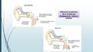 Diferencia anatómica
de la trompa de
Eustaquio en niños y
adultos
 