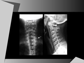 rmn de columna vertebral | PPS
