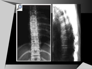 rmn de columna vertebral | PPS