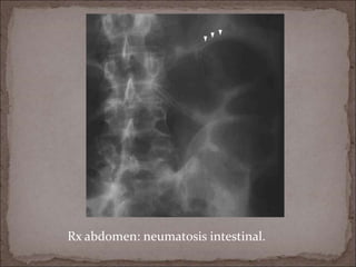 Rx abdomen: neumatosis intestinal.
 