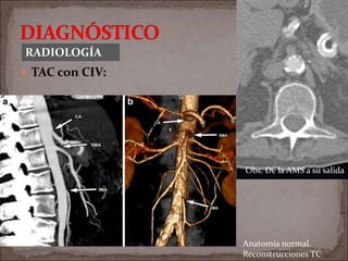 RADIOLOGÍA
 TAC con CIV:
Obs. De la AMS a su salida
Anatomía normal.
Reconstrucciones TC
 