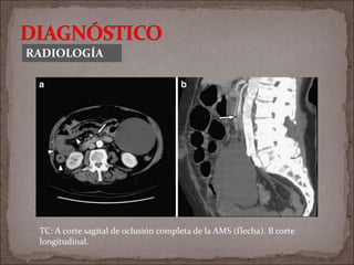 RADIOLOGÍA
TC: A corte sagital de oclusión completa de la AMS (flecha). B corte
longitudinal.
 