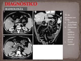 RADIOLOGÍA
TC de
paciente con
TVM:
a. Trombosis
de la VMS
b. Continuac
ión
cefálica
hacia el
sistema
portal
c. Corte
coronal
 