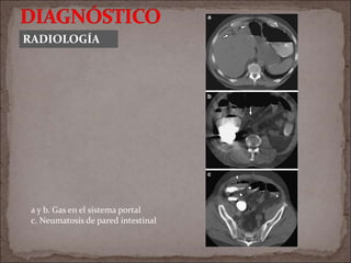 RADIOLOGÍA
a y b. Gas en el sistema portal
c. Neumatosis de pared intestinal
 