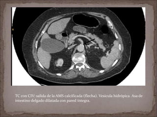 TC con CIV: salida de la AMS calcificada (flecha). Vesícula hidrópica. Asa de
intestino delgado dilatada con pared íntegra.
 