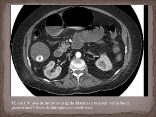 TC con CIV: asas de intestino delgado dilatadas con pared mal definida.
¿neumatosis?. Vesícula hidrópica con colelitiasis.
 