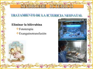 Criação Ria Slides Eliminar la bilirrubina Fototerapia Exanguinotransfusión TRATAMIENTO DE LA ICTERICIA NEONATAL 