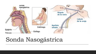 Sonda Nasogástrica
 