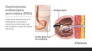 Gastrostomía
endoscópica
percutánea (PEG)
Implantación directamente en el
estómago de una sonda de
silicona que se fija a este y que
sale al exterior a través de la pared
del mismo.
 