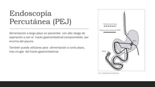 Endoscopía
Percutánea (PEJ)
Alimentación a largo plazo en pacientes con alto riesgo de
aspiración o con el tracto gastrointestinal comprometido por
encima del yeyuno.
También puede utilizarse para alimentación a corto plazo,
tras cirugía del tracto gastrointestinal.
 