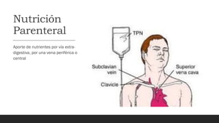 Nutrición
Parenteral
Aporte de nutrientes por vía extra-
digestiva, por una vena periférica o
central
 
