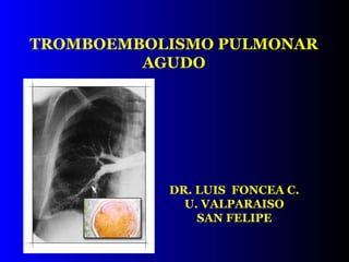 TROMBOEMBOLISMO PULMONAR AGUDO DR. LUIS  FONCEA C. U. VALPARAISO SAN FELIPE 