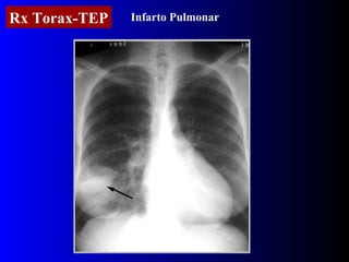 Rx Torax-TEP Infarto Pulmonar 
