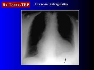 Rx Torax-TEP Elevación Diafragmática 