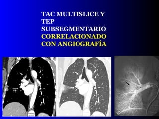 TAC MULTISLICE Y TEP SUBSEGMENTARIO CORRELACIONADO CON ANGIOGRAFÍA 