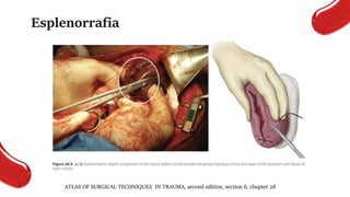 Esplenorrafia
ATLAS OF SURGICAL TECHNIQUES IN TRAUMA, second edition, section 6, chapter 28
 