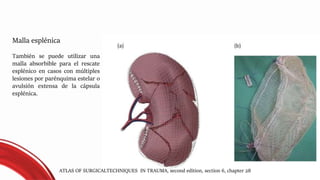 Malla esplénica
También se puede utilizar una
malla absorbible para el rescate
esplénico en casos con múltiples
lesiones por parénquima estelar o
avulsión extensa de la cápsula
esplénica.
ATLAS OF SURGICALTECHNIQUES IN TRAUMA, second edition, section 6, chapter 28
 
