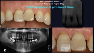 Prof. Ferdinando Zarone
University Federico II Naples-Italy
Tissue management of peri-implant tissue
 