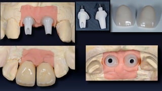 Tissue Management of Peri-implant Tissue