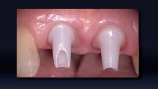 Tissue Management of Peri-implant Tissue