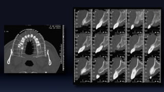 Tissue Management of Peri-implant Tissue