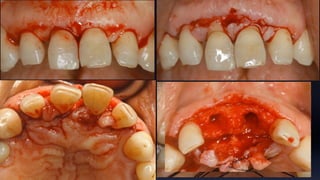 Tissue Management of Peri-implant Tissue