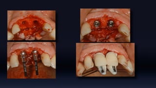 Tissue Management of Peri-implant Tissue